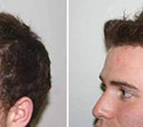 Feller & Bloxham Hair Transplantation - Great Neck, NY