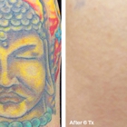 Laser Tattoo Removal by Tatt Cemetery