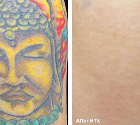 Laser Tattoo Removal by Tatt Cemetery - Fort Myers, FL