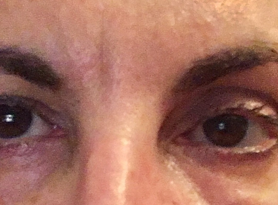 Derma Laser Center - Hallandale Beach, FL. Horrible! See what they did on my eyes they have applied a wrong amount of Botox on my forehead, now my right eye is totally down