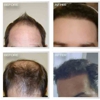 Natural Transplants, Hair Restoration Clinic gallery