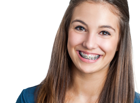 Summit Orthodontics - Upland, CA. Beautiful Smile - Braces at Summit Orthodontics