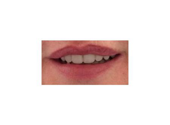 Advanced Dental Prosthetics Clinic - Warners Bay, NSW