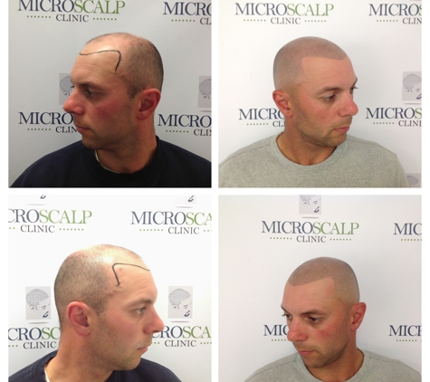 Micro Scalp Clinic - Boston, MA