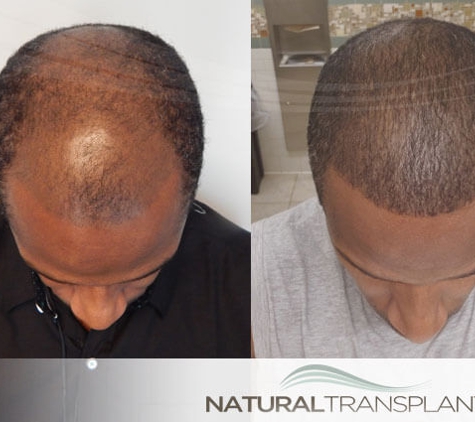 Natural Transplants, Hair Restoration Clinic - Fort Lauderdale, FL