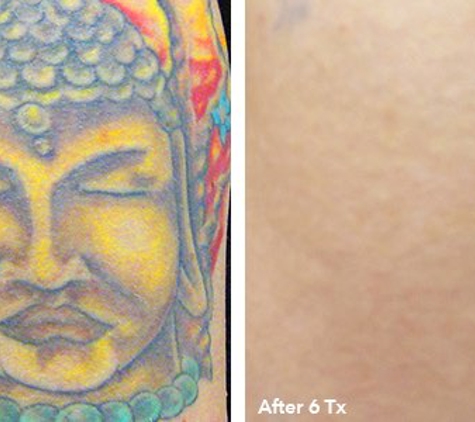 Eraser Clinic Laser Tattoo Removal - San Antonio, TX