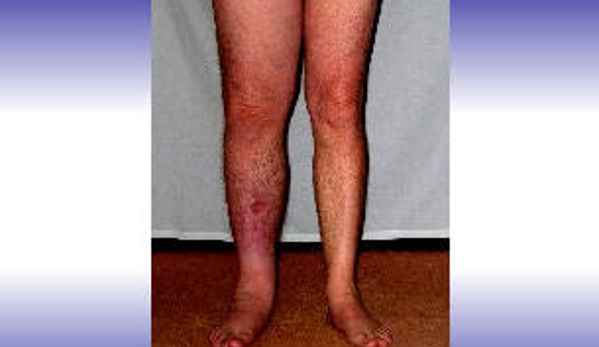 Lymphoedema Clinic Adelaide - Walkerville, SA