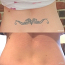 Removery Tattoo Removal & Fading - Tattoo Removal