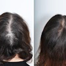 PRP Hair Loss Treatment Center - Hair Replacement