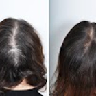PRP Hair Loss Treatment Center
