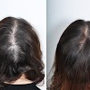 PRP Hair Loss Treatment Center