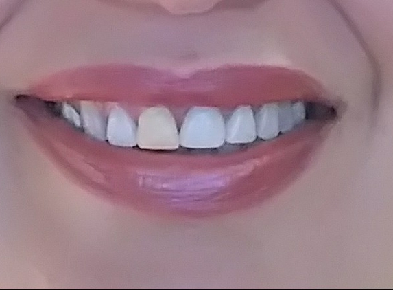 Michael M Meliza, DDS - Houston, TX. was not able to fit in middle crowns. middle crown is placed at an angle. she (purposely I am sure) made this temporary yellow crown for me.