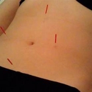 Rose City Acupuncture - Acupuncture
