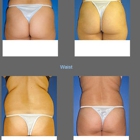 Arizona Lipo Clinic