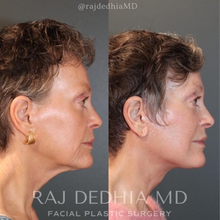 Raj Dedhia, MD Facial Plastic Surgery - San Francisco, CA