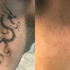 TakeTatt Tattoo Removal gallery