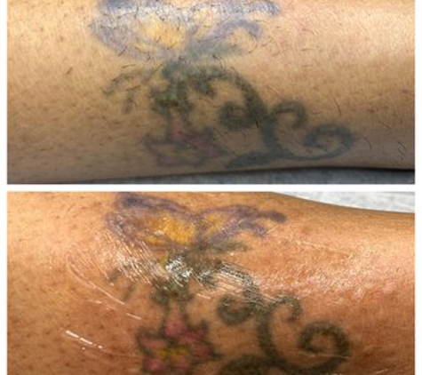 Electrolysis Beauty Lounge - Bloomfield, NJ. before-and-after - Electrolysis hair removal over tattoo