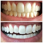Glintr Mobile Teeth Whitening
