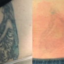 TakeTatt Tattoo Removal - Tattoo Removal