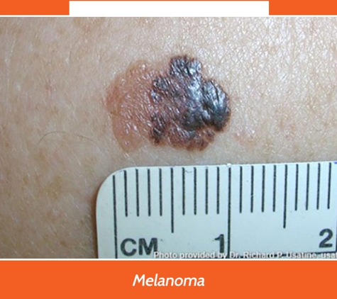 Port Macquarie Skin Cancer Clinic - Port Macquarie, NSW. Melanoma
