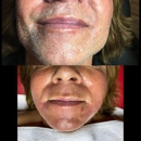 Electrolysis Center Laser Hair Removal - Hair Removal