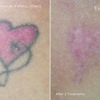 Inkfree, MD Laser Clinic gallery