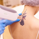 Ink-B-Gone - Tattoo Removal