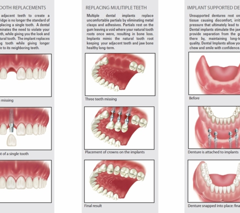Dental Implants Orange - Orange, NSW