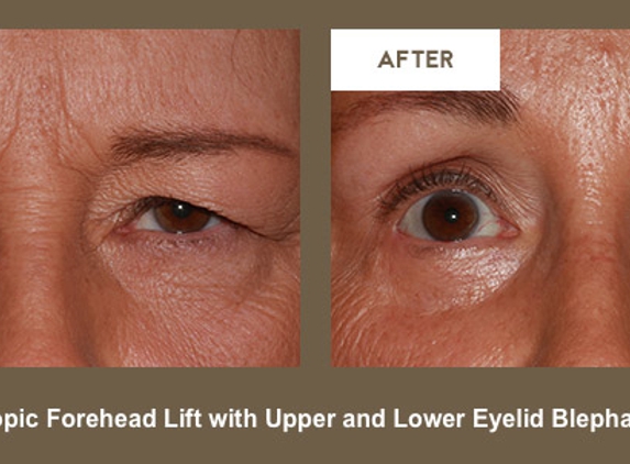 Klapper Eyelid & Facial - Indianapolis, IN