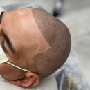 Scalp Micro SD - Hair Replacement