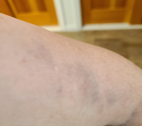 Central Valley Chiropractic - Fresno, CA. Bruises from Massage
