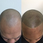 Full Micropigmentation