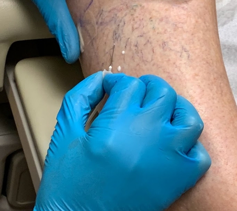 Charming Skin Vein Clinics - Chicago, IL. Sclerotherapy for spider Veins