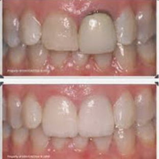 Smiles By Alex - Fountain Valley, CA. Cerec Crowns Fountain Valley, CA