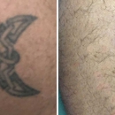 ReversaTatt - Tattoo Removal