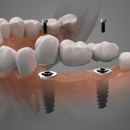 Smile on Implants Dental Centers - Prosthodontists & Denture Centers