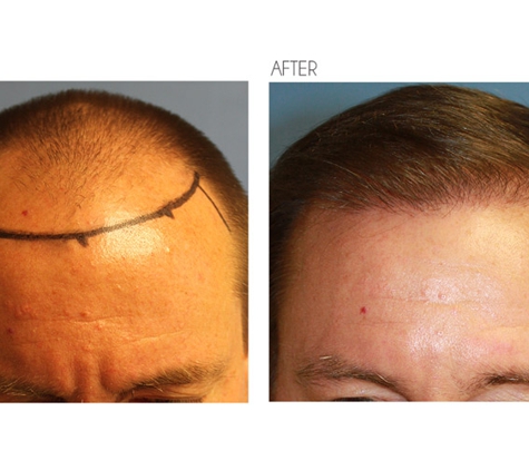 Beverly Hills Hair Restoration - Beverly Hills, CA