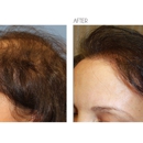 Beverly Hills Hair Restoration - Hair Replacement