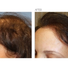 Beverly Hills Hair Restoration