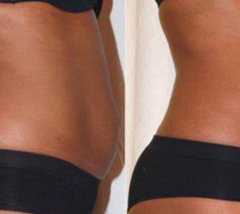 Skulpted Skin the Body Contouring Specialist - Round Rock, TX