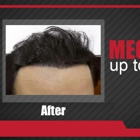 MAXIM Hair Restoration