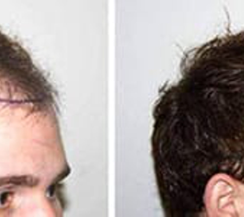 Feller & Bloxham Hair Transplantation - Great Neck, NY