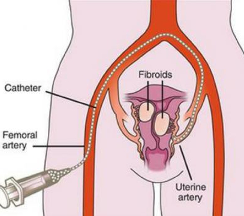 USA Fibroid Centers - Brooklyn, NY