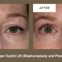 Klapper Eyelid & Facial