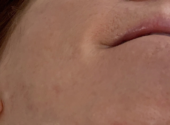 The Art of Aesthetics Med Spa LLC - Columbia, SC. Mamie Holas nicked my chin during the dermaplaning procedure.