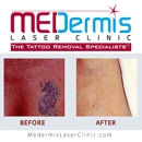 MEDermis Tattoo Removal - Tattoo Removal