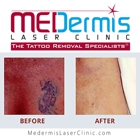 MEDermis Tattoo Removal