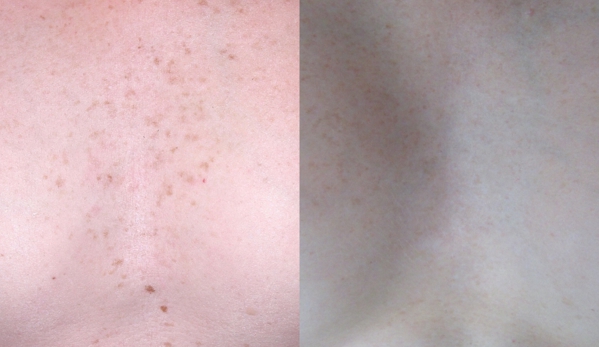 Crystal Skin Care - Kaysville, UT. Cryoprobe: Before and After