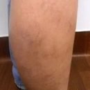 Shapiro Vein Center