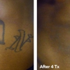 Eraser Clinic Laser Tattoo Removal gallery